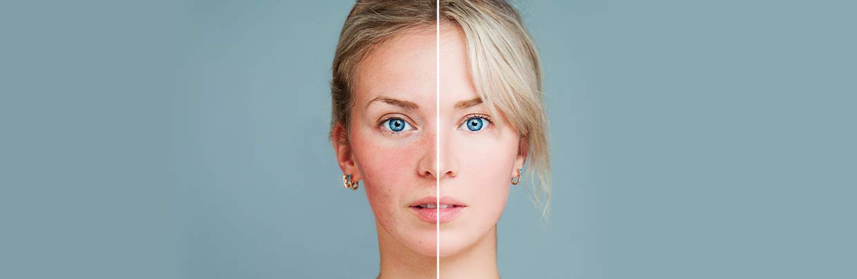 Rosacea Die richtige Behandlung bei Rosacea