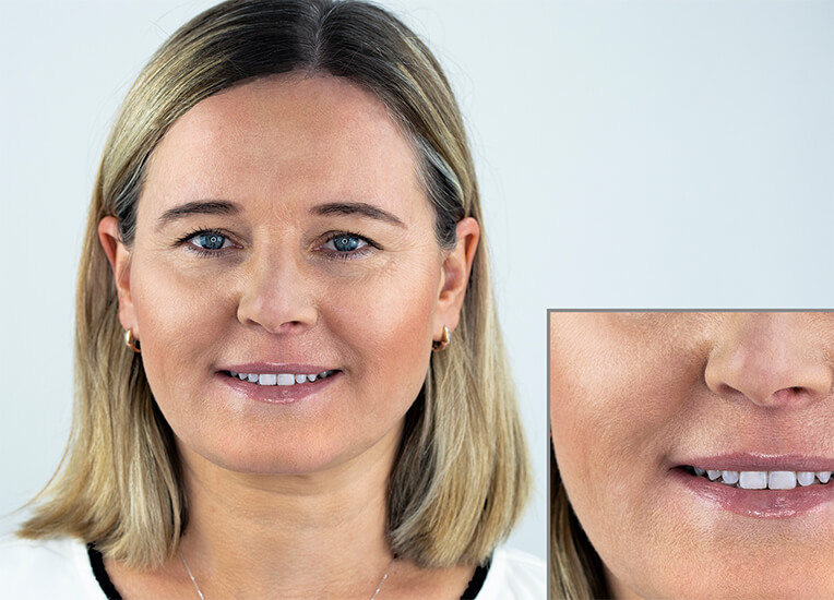 Ampoule Treatment After After Picture