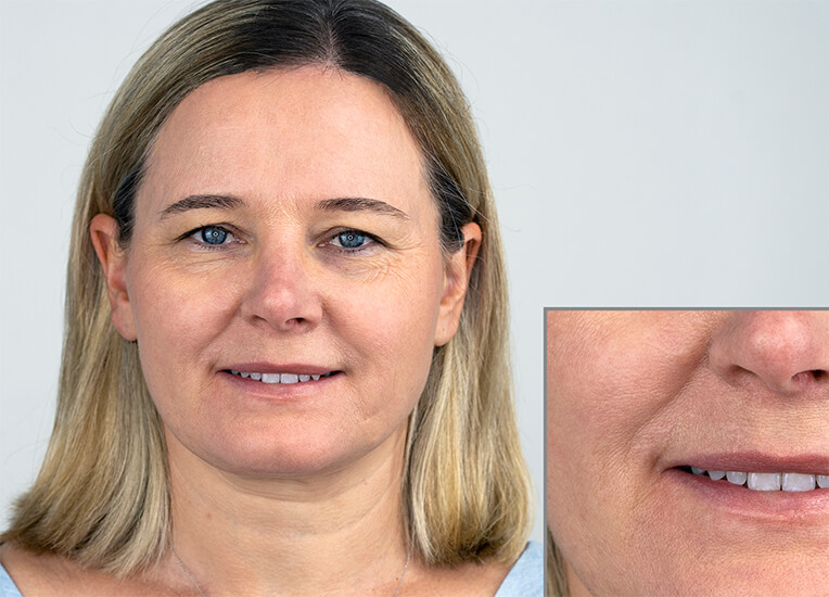 Hautbild Ampullenkur Vorher Hautbild vor der Ampullenkur