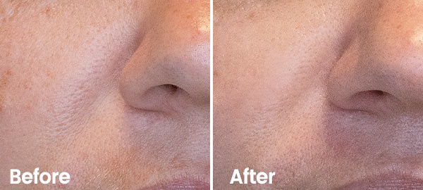 Nasolabial fold - before & after Result Hydrafacial Nasolabial fold