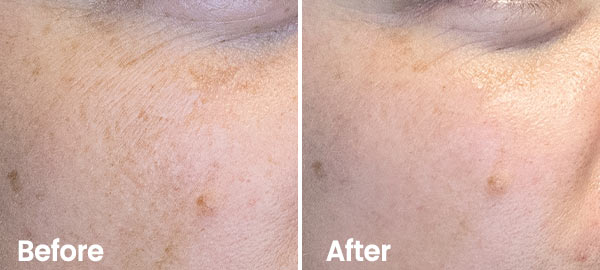 Pigmentation spots - before & after Result Hydrafacial Pigment spots