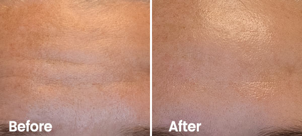Forehead wrinkles - before & after Reduce forehead wrinkles with hydrafacial treatment