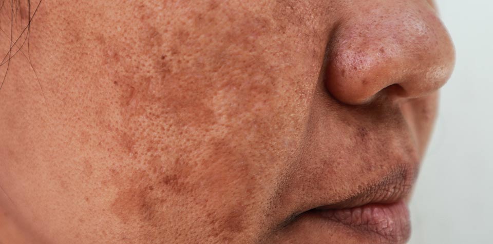 Hormonelle Hyperpigmentierung Melasma – Ursachen und Behandlung