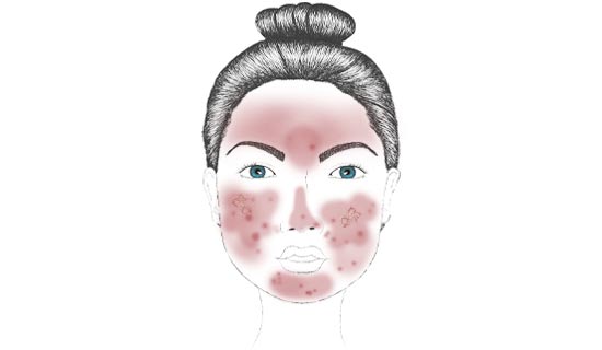 Rosacea papulopustulosa Entzündungen, Pusteln und Papeln bei Rosacea