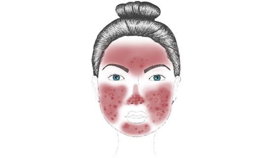 Glandulär-hyperplastische Rosacea Die schwerste Form von Rosacea