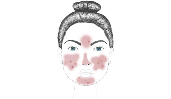 Rosacea erythematosa-teleangiectatica Die leichte Form von Rosacea