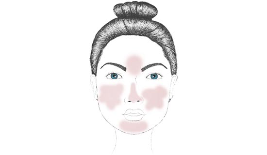 Rosacea-Diathese Die Vorstufe von Rosacea