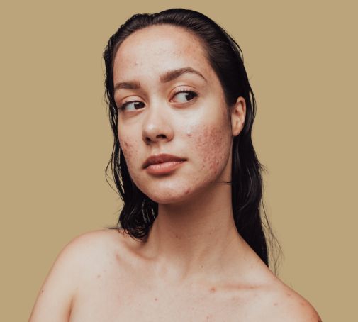 Non-comedogenic skincare What does comedogenic mean