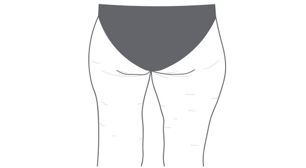 Stages of cellulite