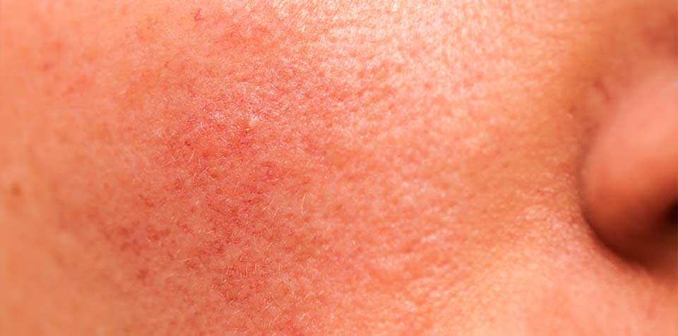 Stress can aggravate eczema, hives and rashes