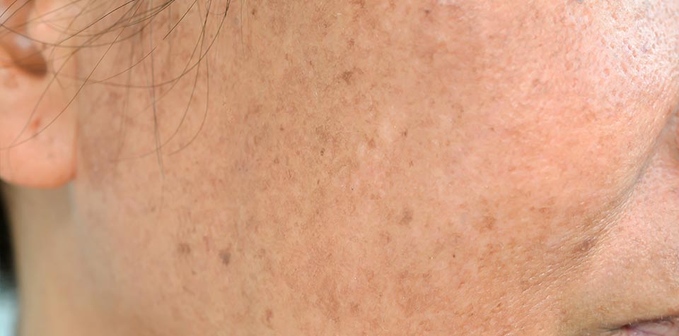 Hyperpigmentation – frequently asked questions