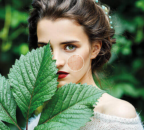 Pelle con couperose Pelle con couperose