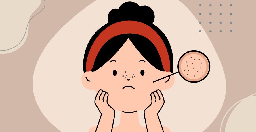 Mitesser auf der Nase entfernen 