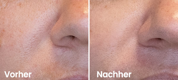 Nasolabialfalte Vorher-Nachher Ergebnis Hydrafacial Nasolabialfalte