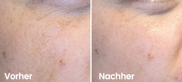 Pigmentflecken Vorher-Nachher Ergebnis Hydrafacial weniger Pigmentflecken