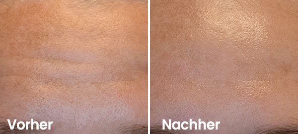 Stirnfalten Vorher-Nachher Weniger Stirnfalten nach Hydrafacial Behandlung