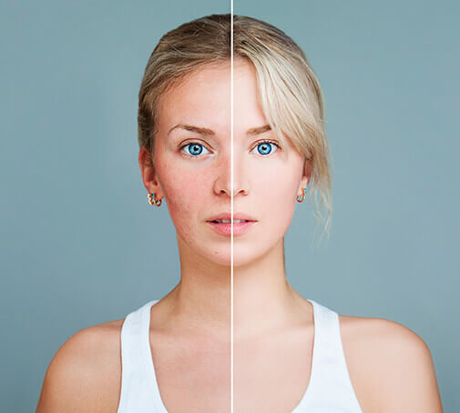 Was tun bei Rosacea