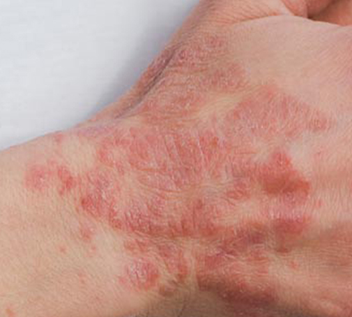 Quale unguento usare contro l’eczema