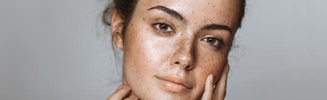 How to get rid of dark spots