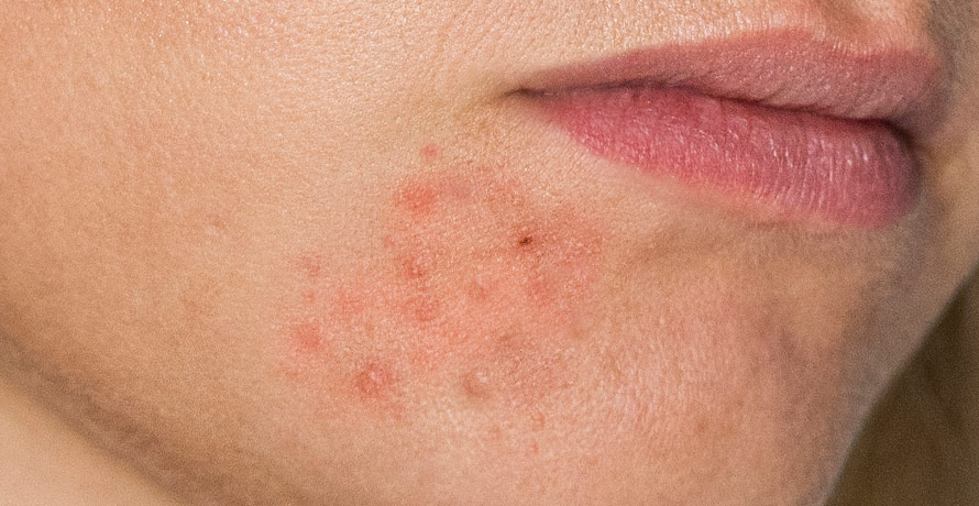 Dermatitis symptom red rash