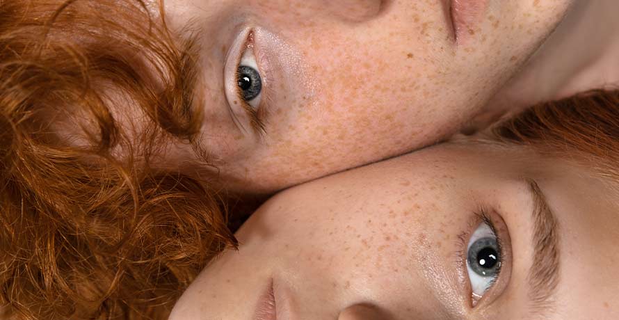 Hyperpigmentation