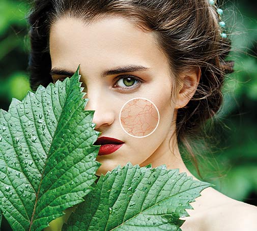 Couperose - Control skin prone to redness