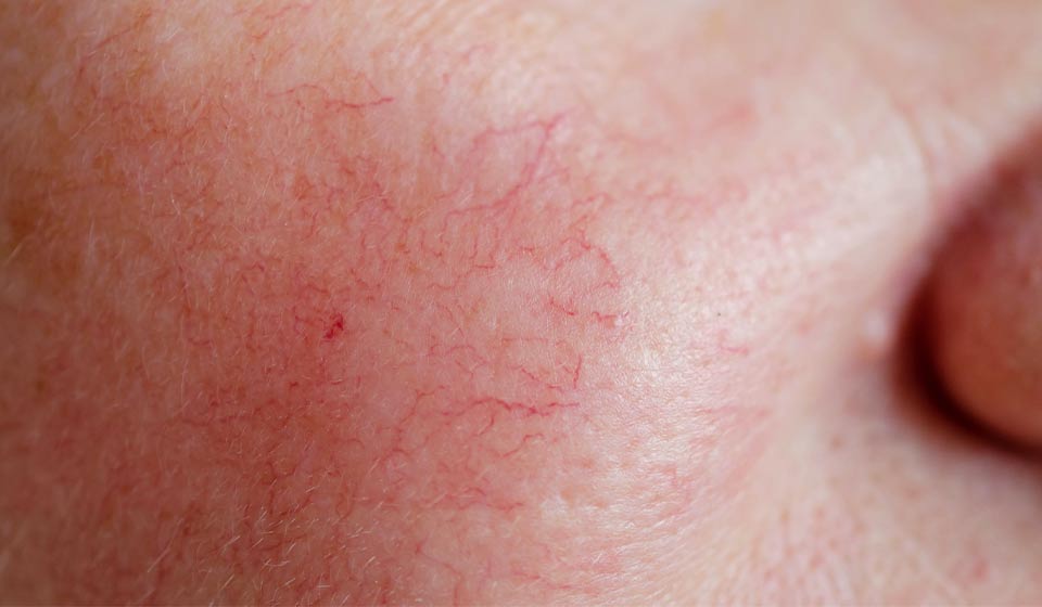 Rosacea symptoms What is rosacea