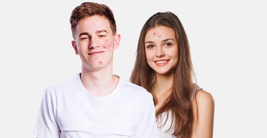 Pelle a tendenza acneica e impura 