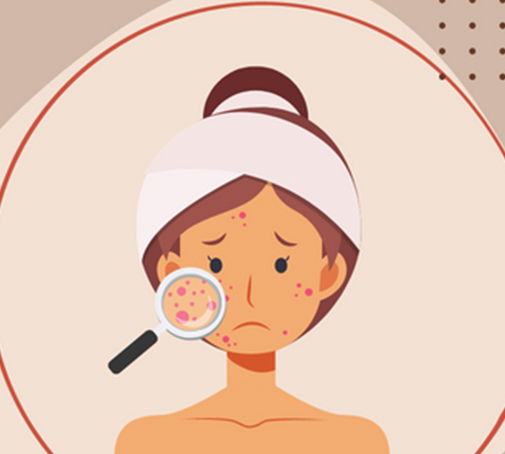 Pimple Guide How to get rid of pimples