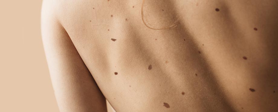 What causes skin to darken?