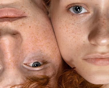 Disturbi della pigmentazione 