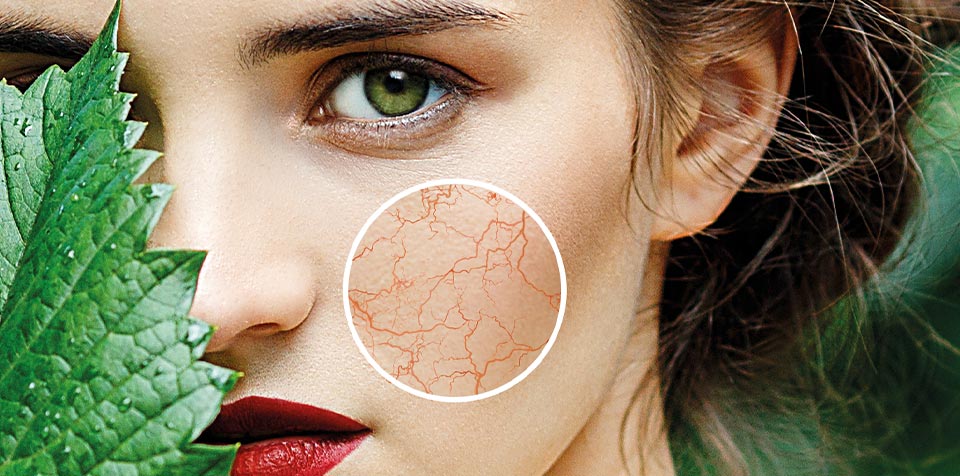 Couperose symptoms What is couperose