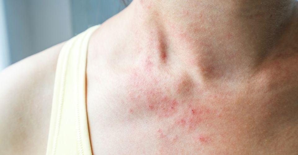 Causes of redness Eczema and perioral dermatitis