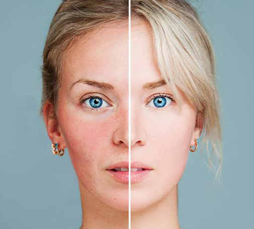 Trattamenti per la rosacea