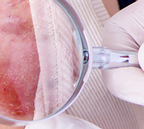 Come insorge l’acne inversa?