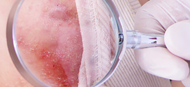 Acne Inversa Acne Inversa behandeln