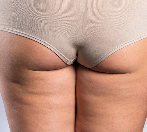 Cellulite und schwaches Bindegewebe