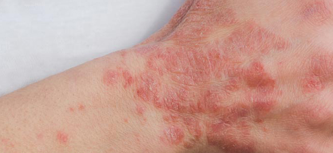 Trattare l’eczema nel modo giusto Quale unguento usare contro l’eczema