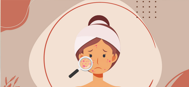 Pimple Guide How to get rid of pimples