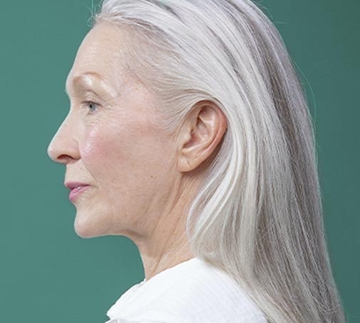 Wechseljahre Hautprobleme in den Wechseljahren