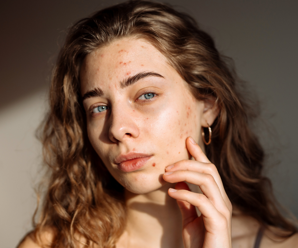 Face skin blemishes Skin blemish face