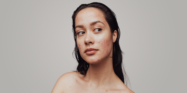 Skincare for acne prone skin Removing facial blemishes