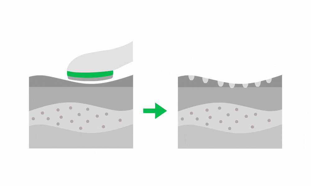 Fusion Plasma Mode SkinFusion makes the skin more permeable for ingredients