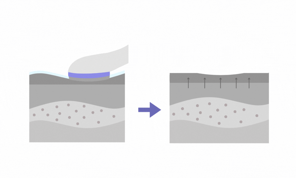 Microcurrent mode SkinFusion provides a visible lifting effect