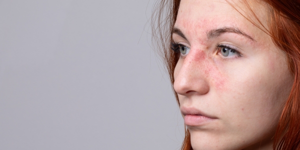 Überempfindliche Haut richtig pflegen