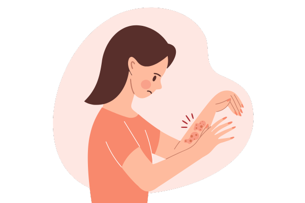 How stress affect your skin Stress can aggravate eczema, hives and rashes