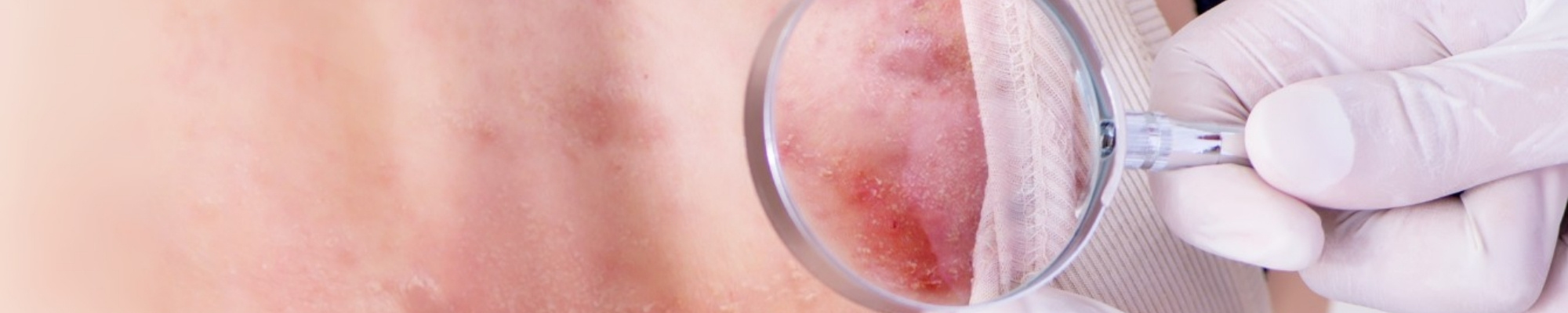 Acne inversa How to treat Hidradenitis suppurativa?