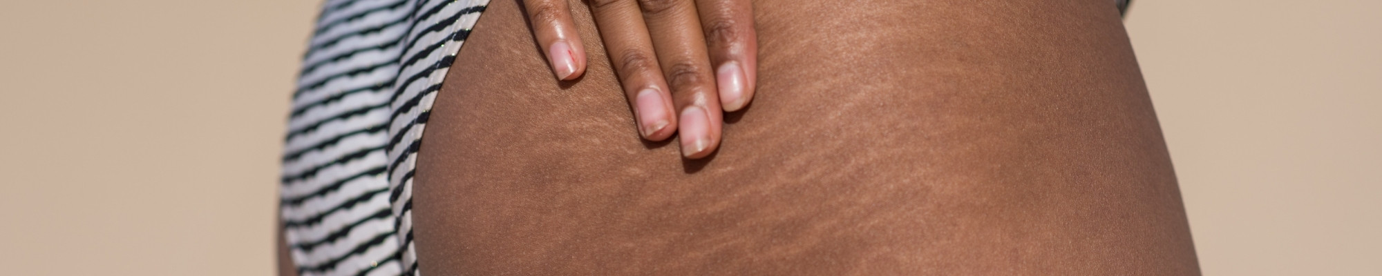 Can stretch marks go away