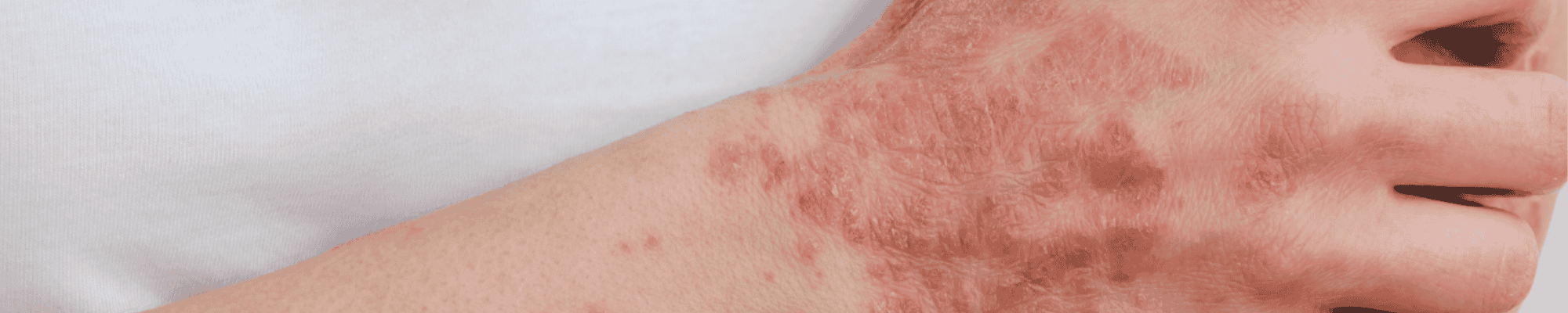 Trattare l’eczema nel modo giusto Quale unguento usare contro l’eczema
