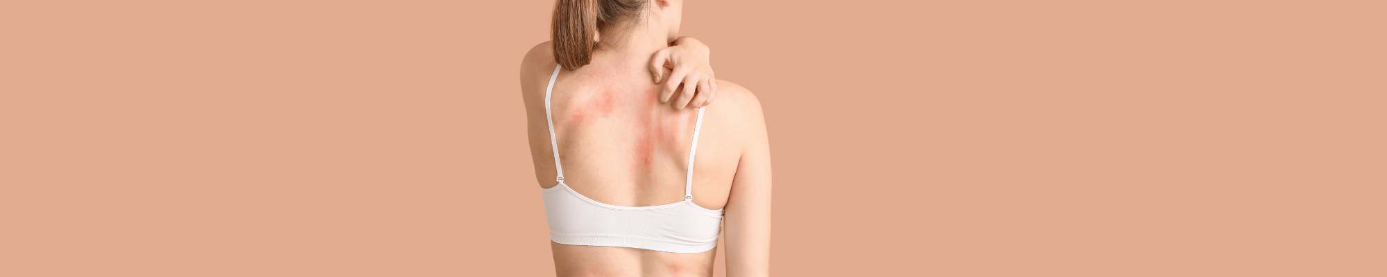 Eczema treatment Eczema therapy